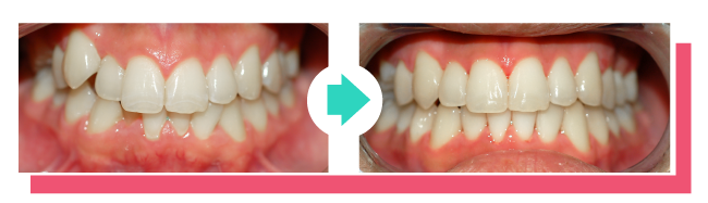 ClearCorrect aligners before and after