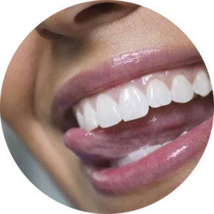 Weisse Zähne nach einem professionellen Bleaching